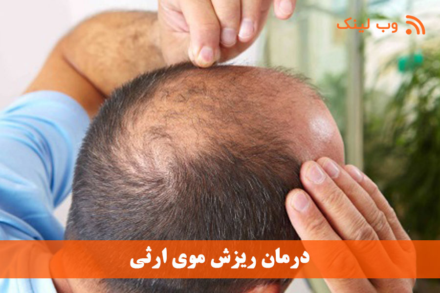 درمان ریزش موی ارثی